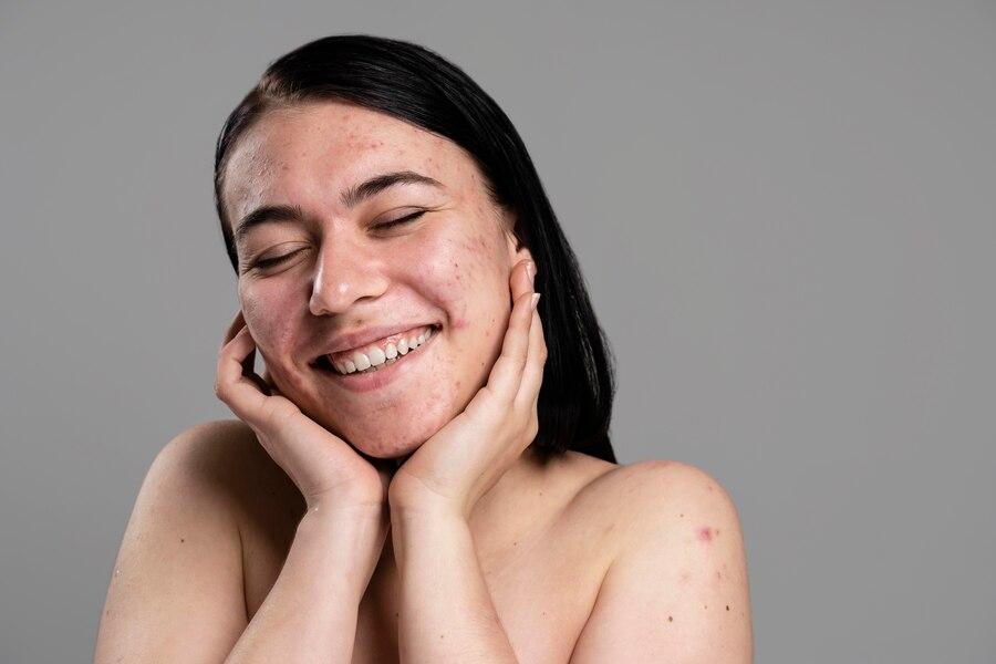 Possíveis causas e tratamentos para o aumento de acne na pele